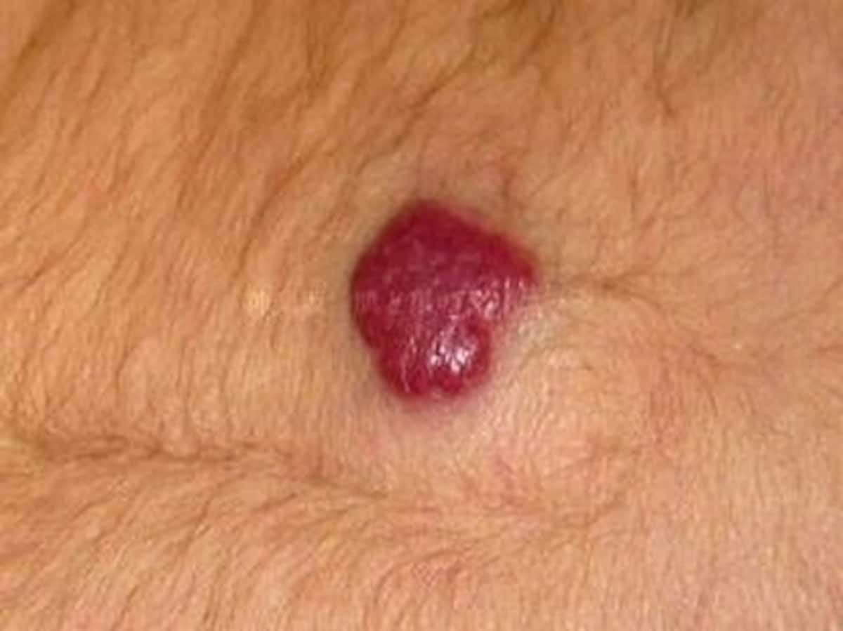 血管腫（乳児血管腫）