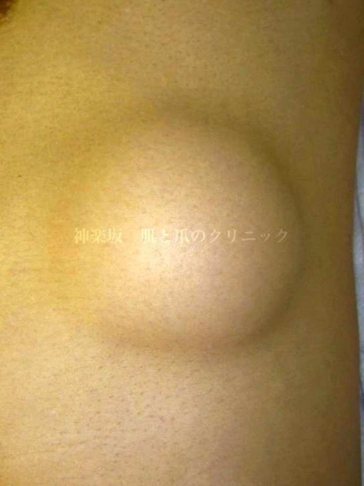 脂肪腫