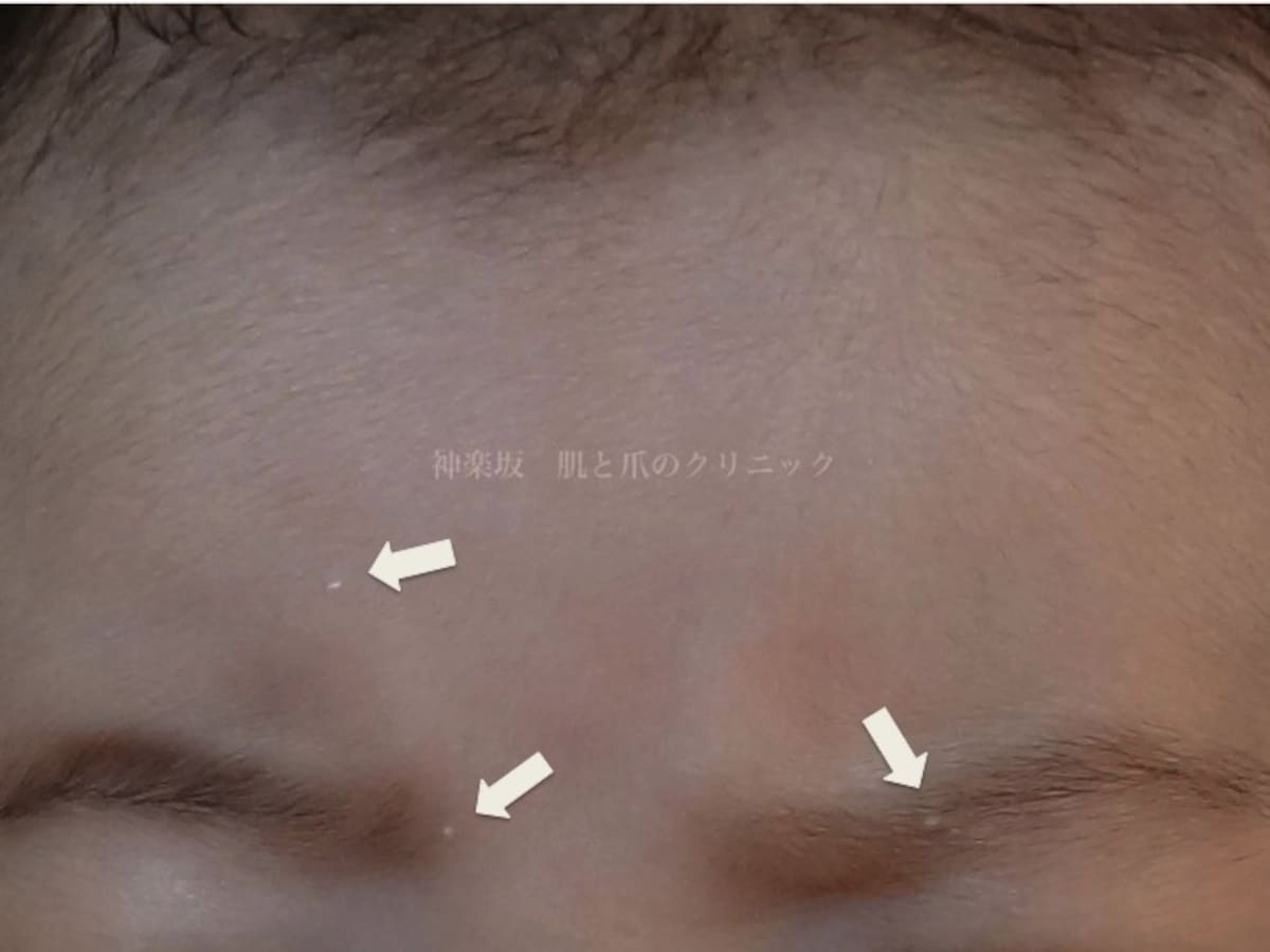 稗粒腫（乳児）