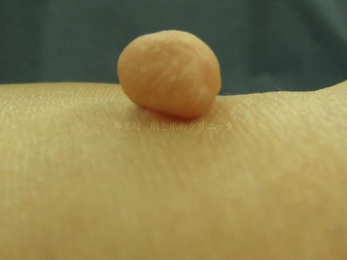 軟性線維腫