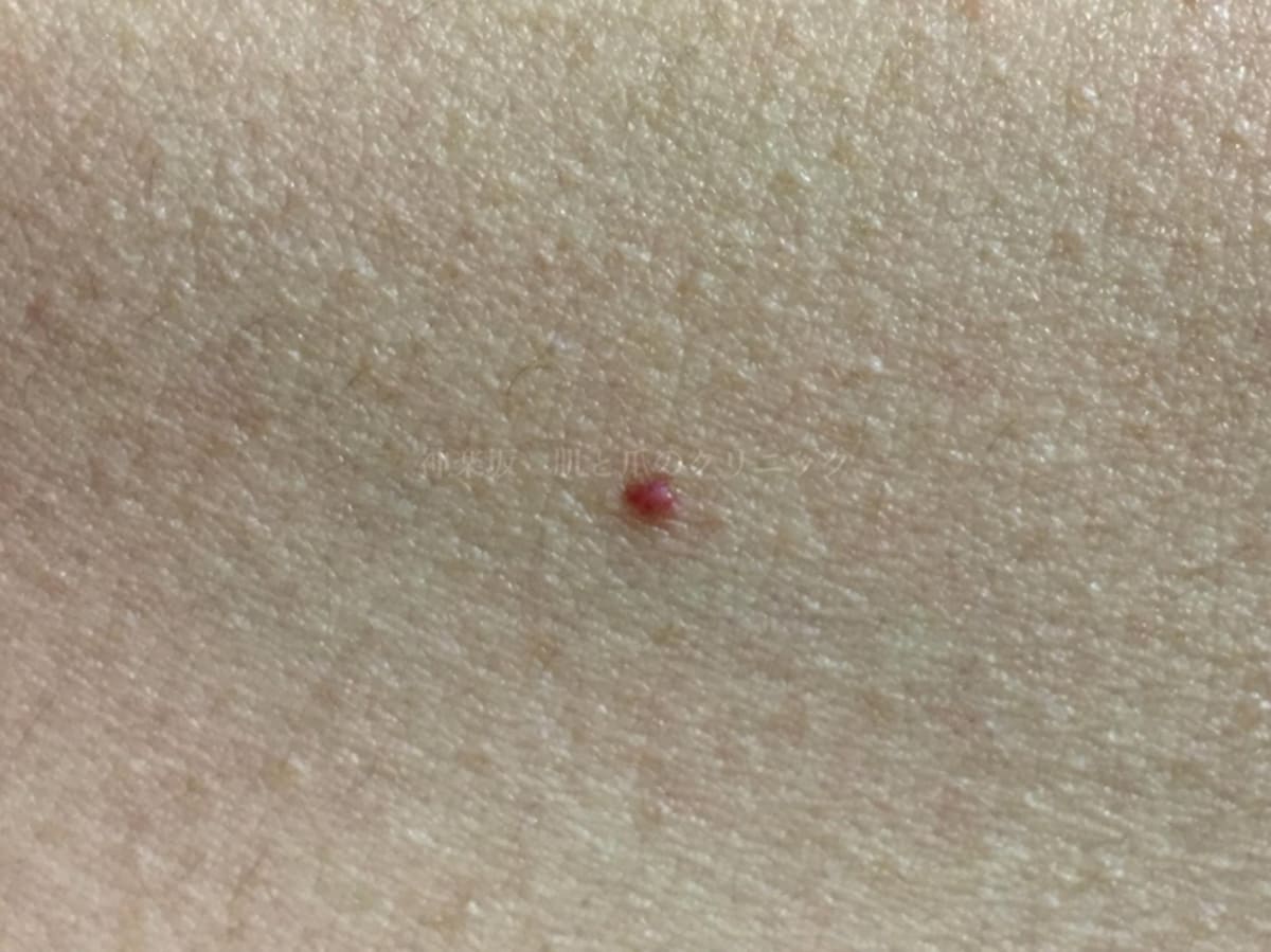 老人性血管腫