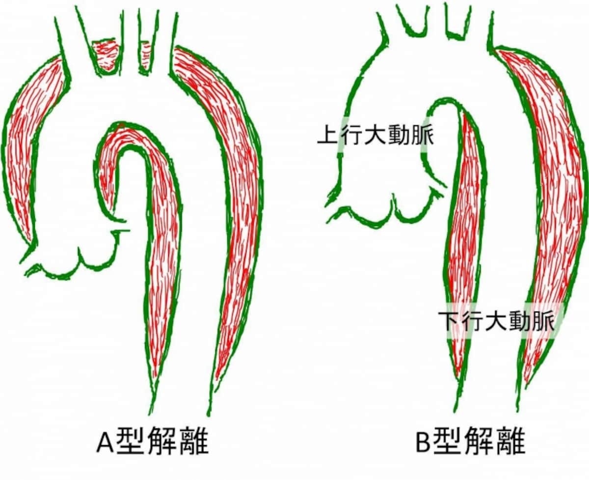 大動脈解離、A型とB型