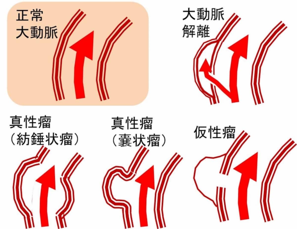 大動脈瘤のいろいろ