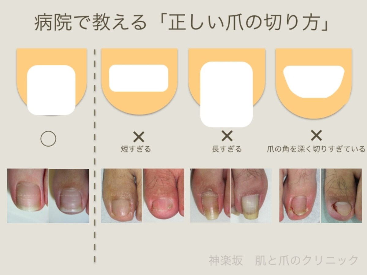正しい爪の切り方