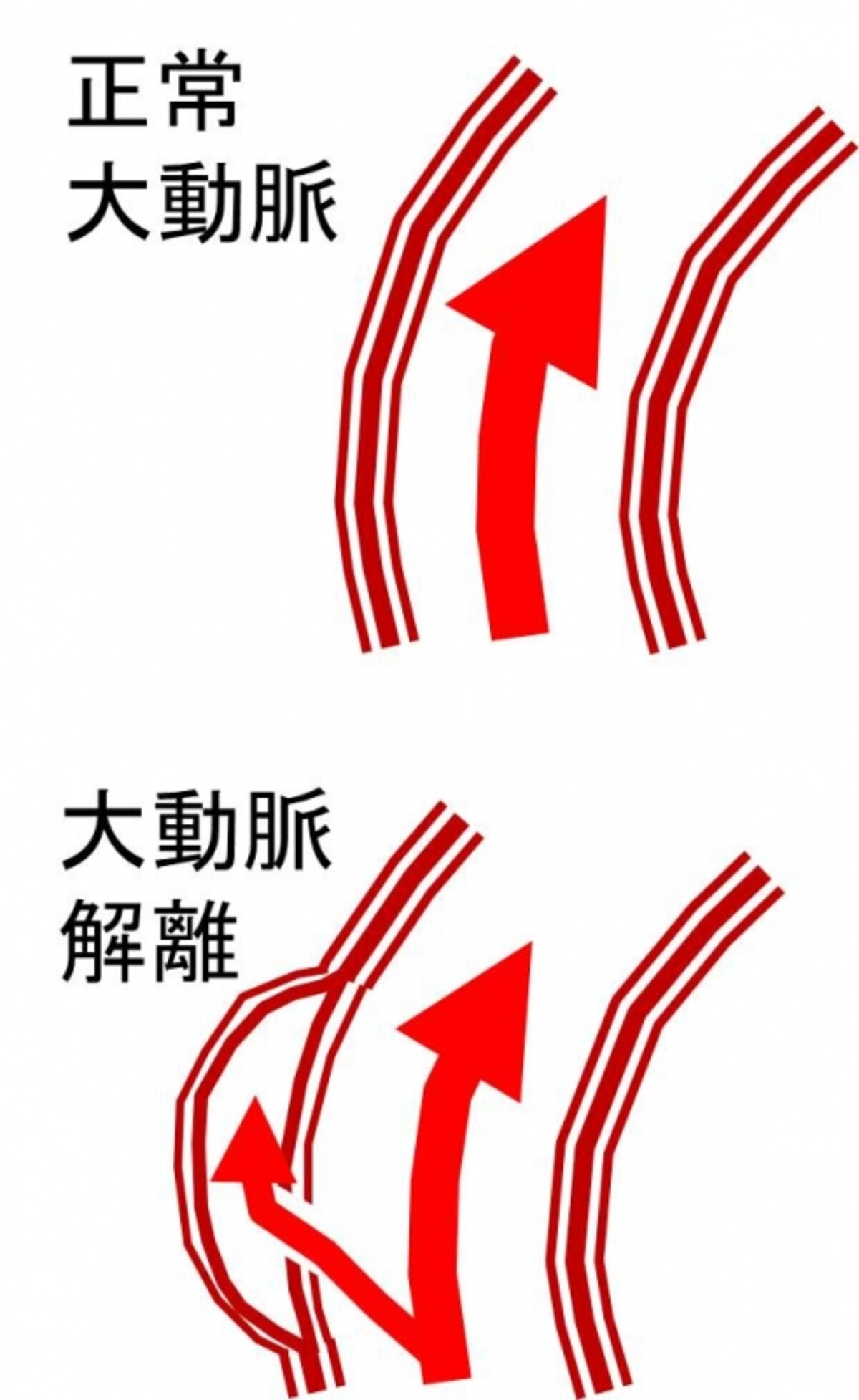 大動脈解離の起こり方