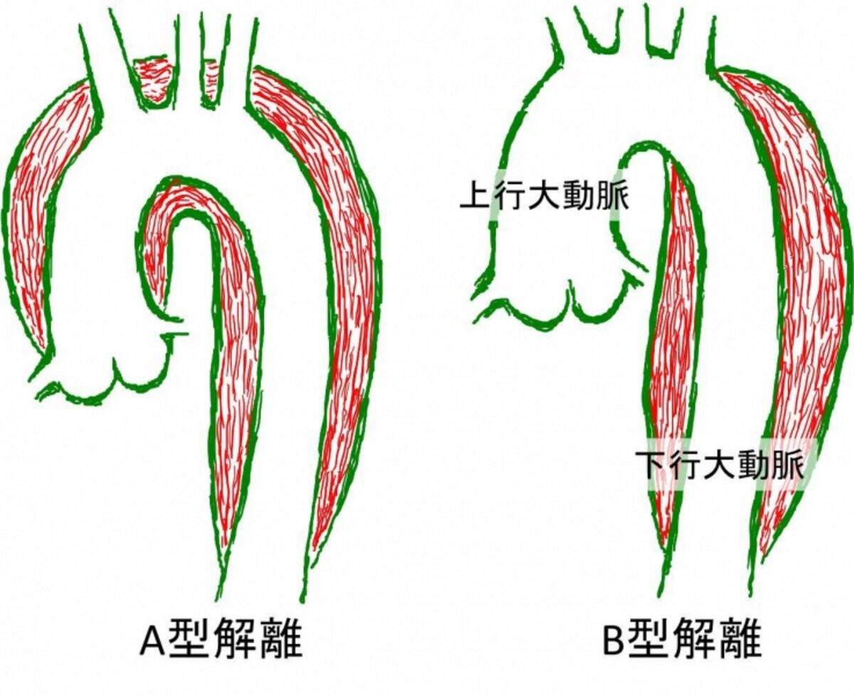 A型解離とB型解離
