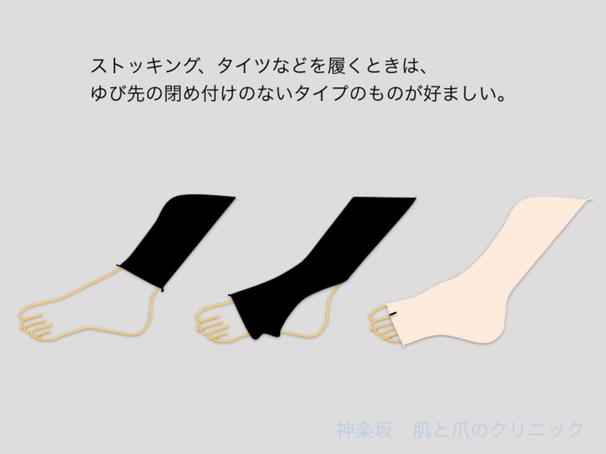 巻き爪に好ましいタイツのタイプ