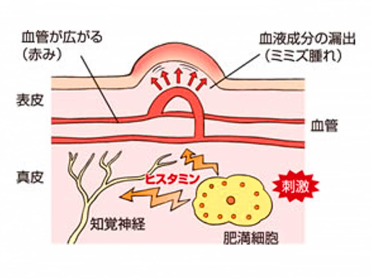 じんましん　イラスト