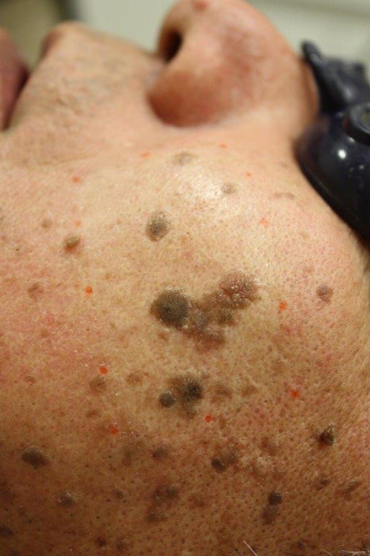 脂漏性角化腫