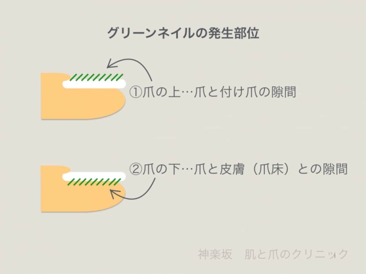 グリーンネイルの発生部位