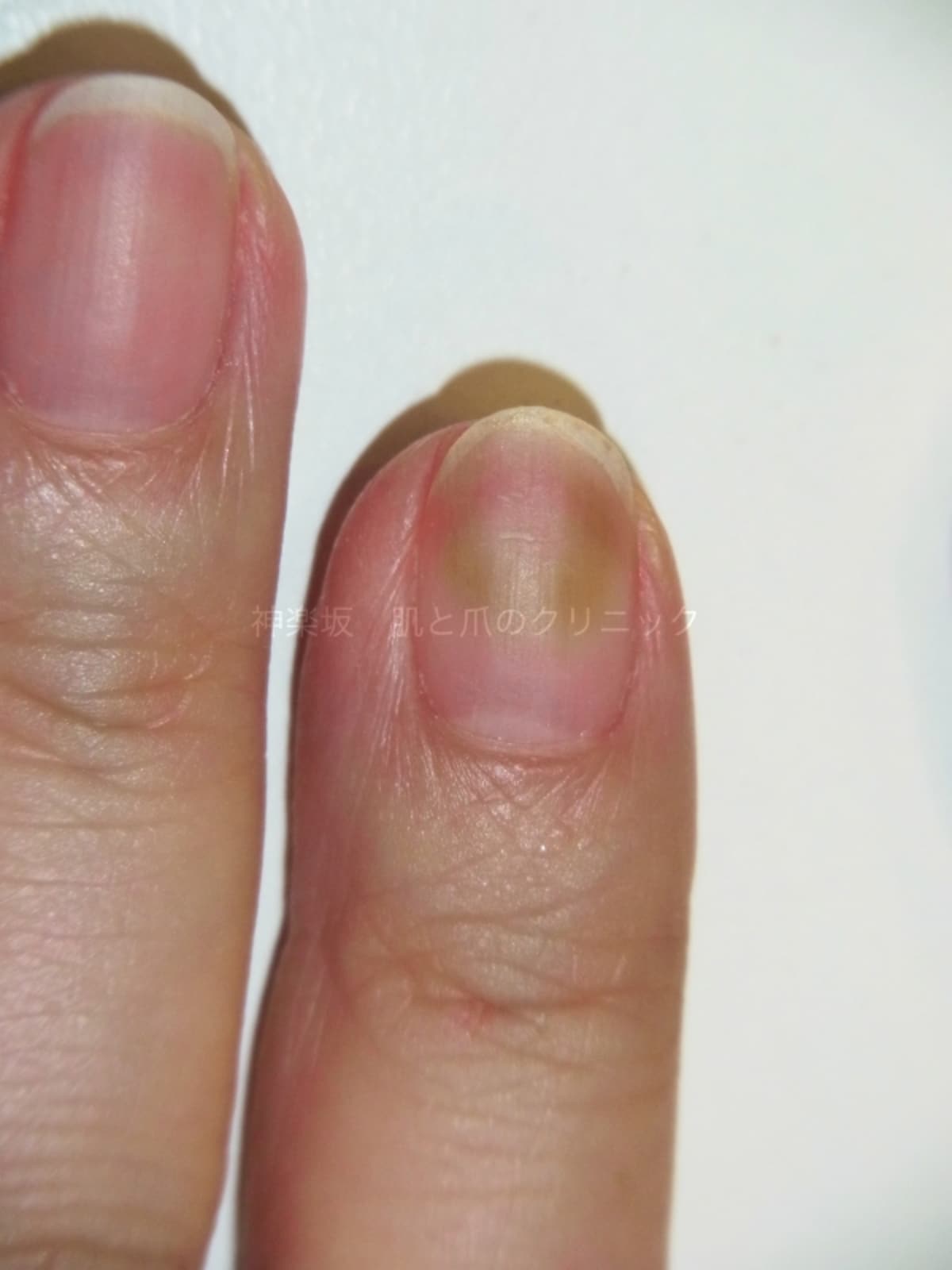 自爪とジェルネイルの隙間の感染