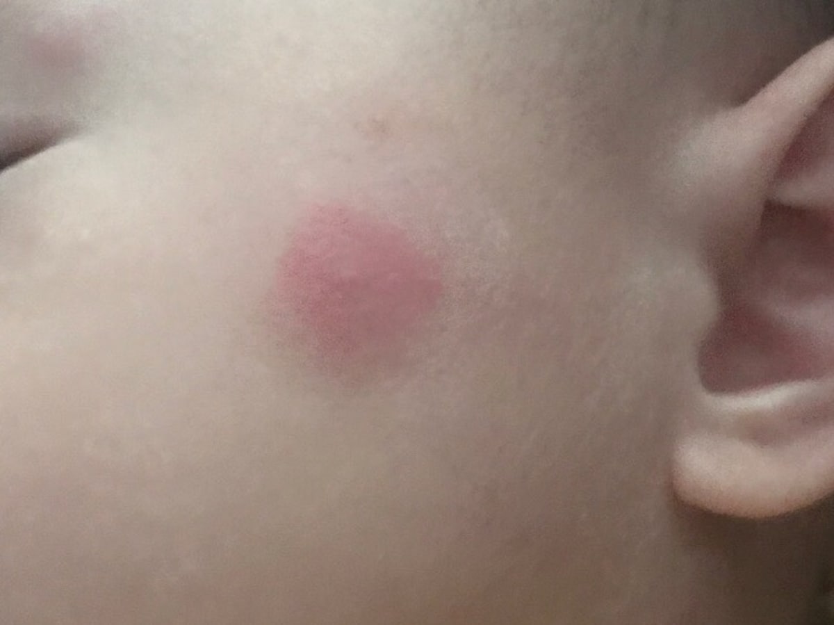 虫刺されの写真