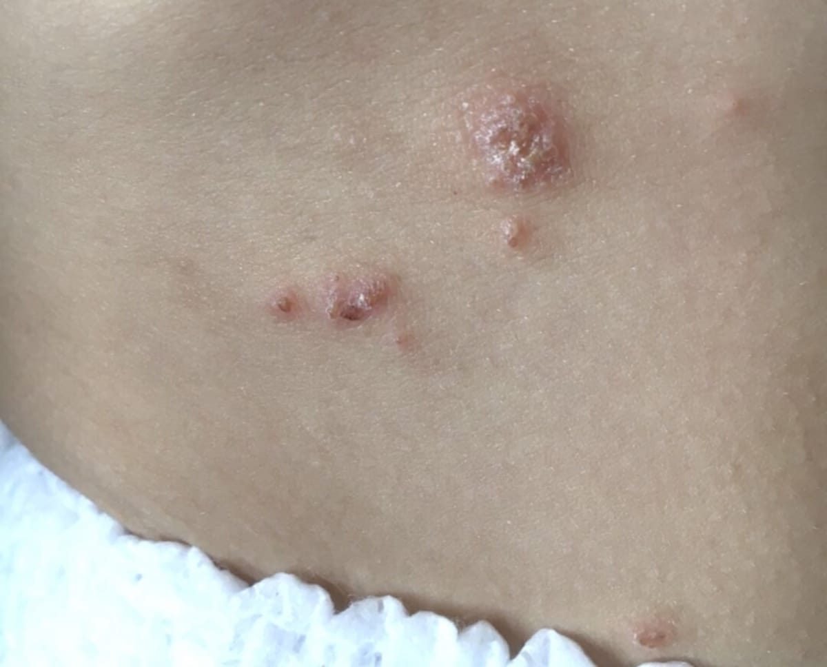 とびひの写真・症例画像