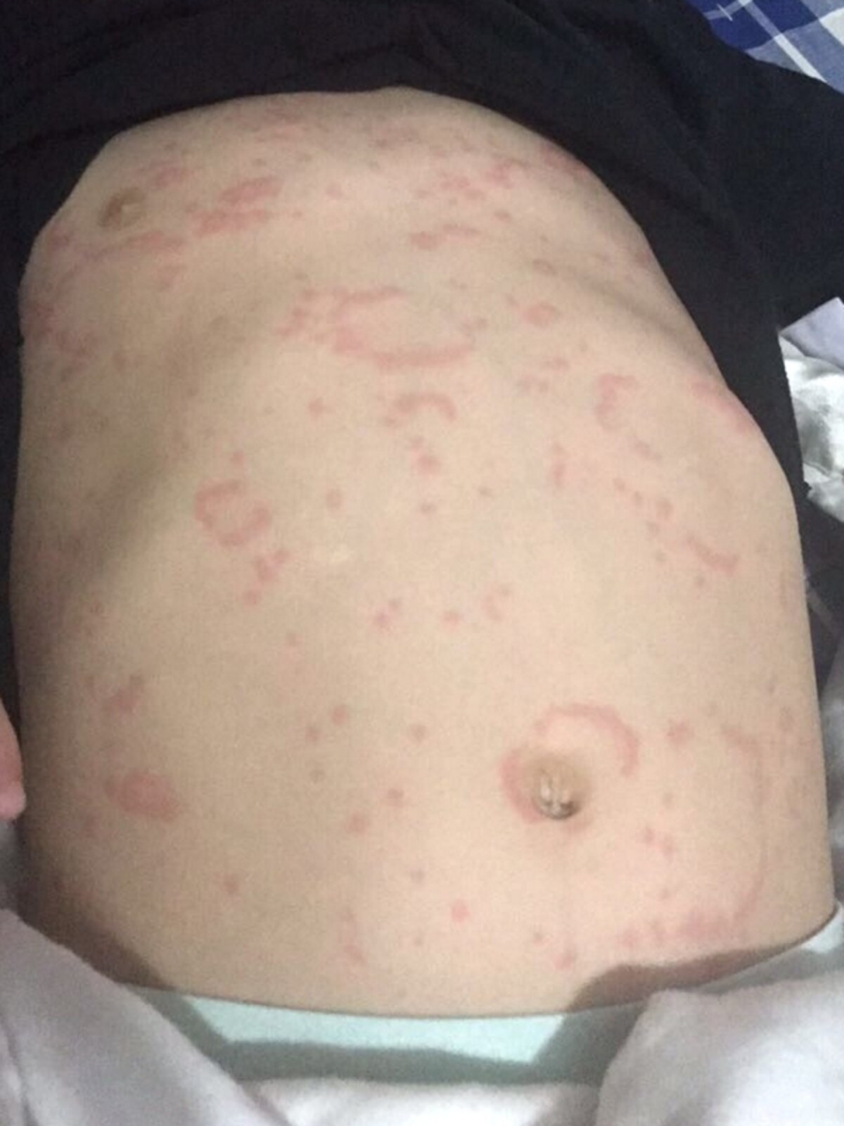 環状蕁麻疹の写真