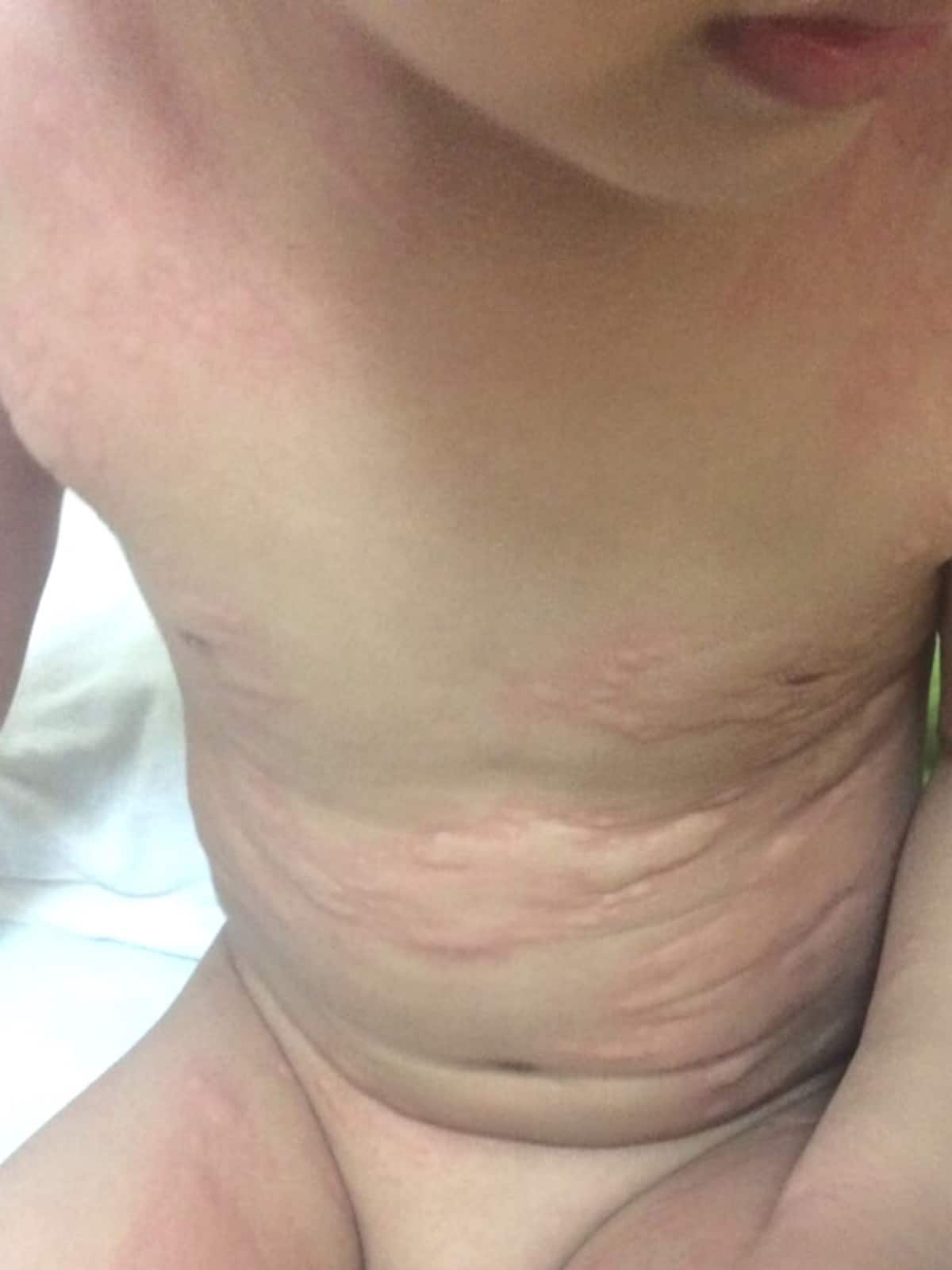 子どもの蕁麻疹の写真