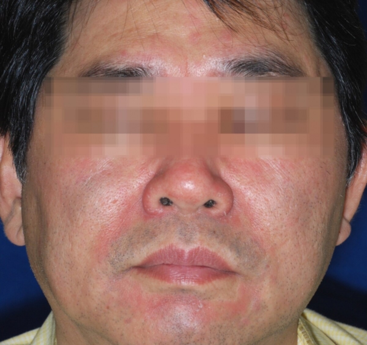 脂漏性皮膚炎の症例画像・写真・成人