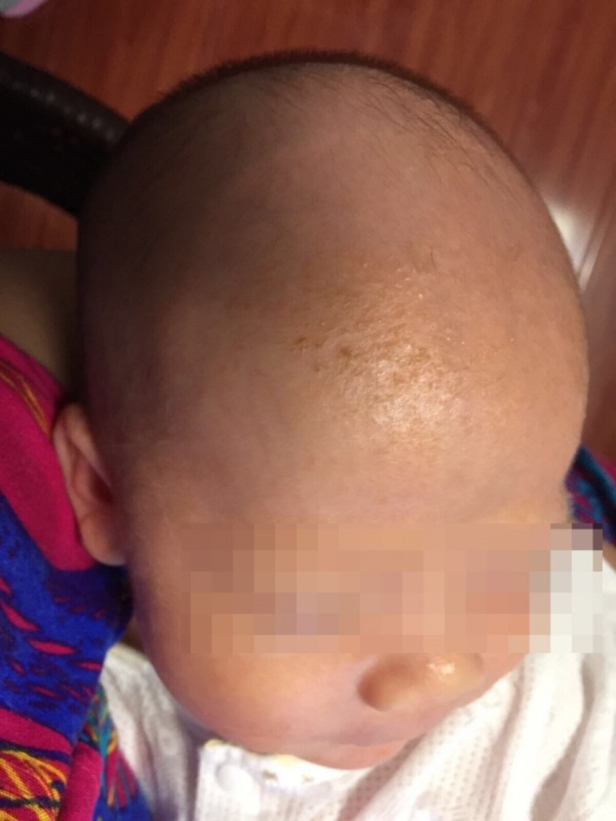 乳児の脂漏性皮膚炎写真
