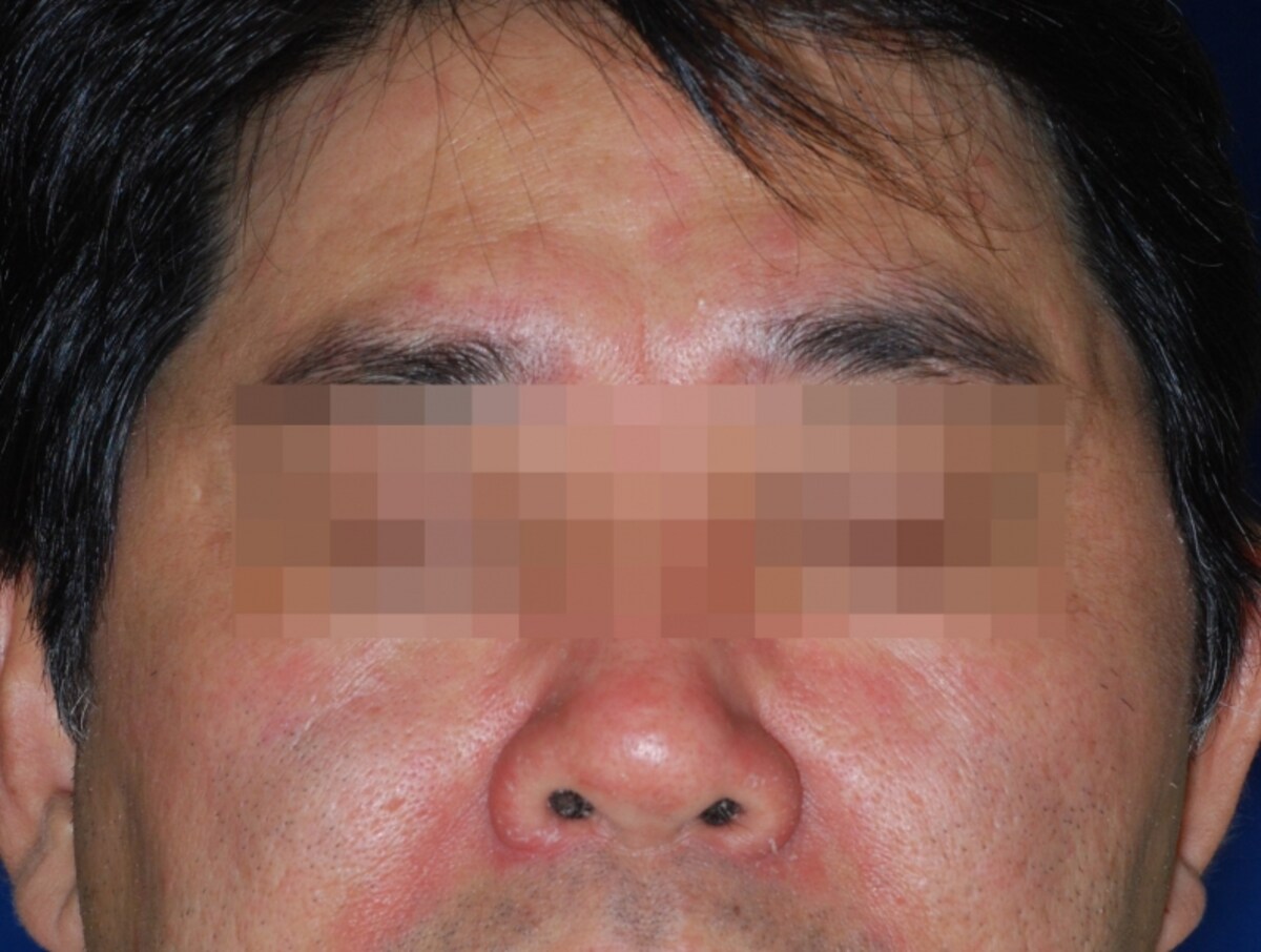 脂漏性皮膚炎の症例画像・写真・成人