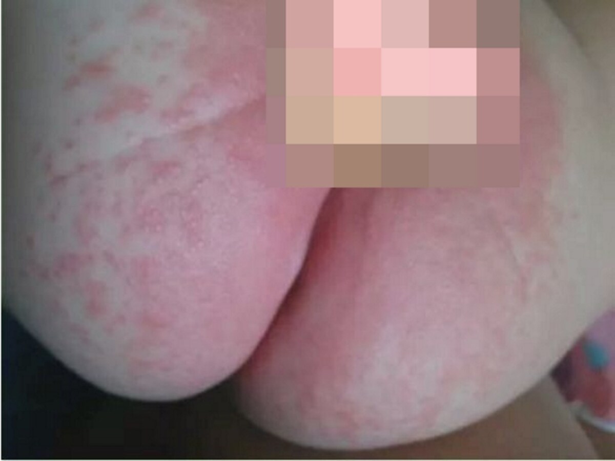 おむつかぶれの症例写真