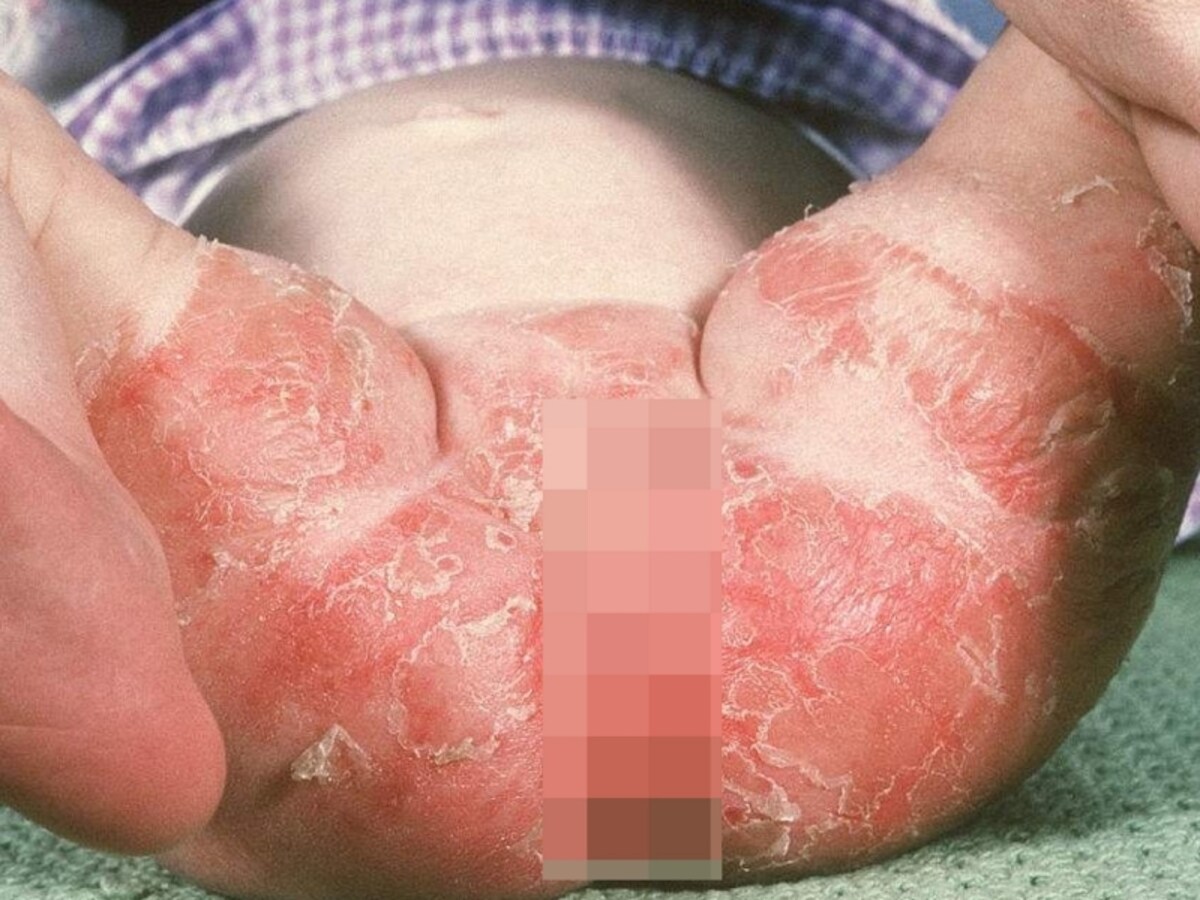 重度のおむつかぶれの写真