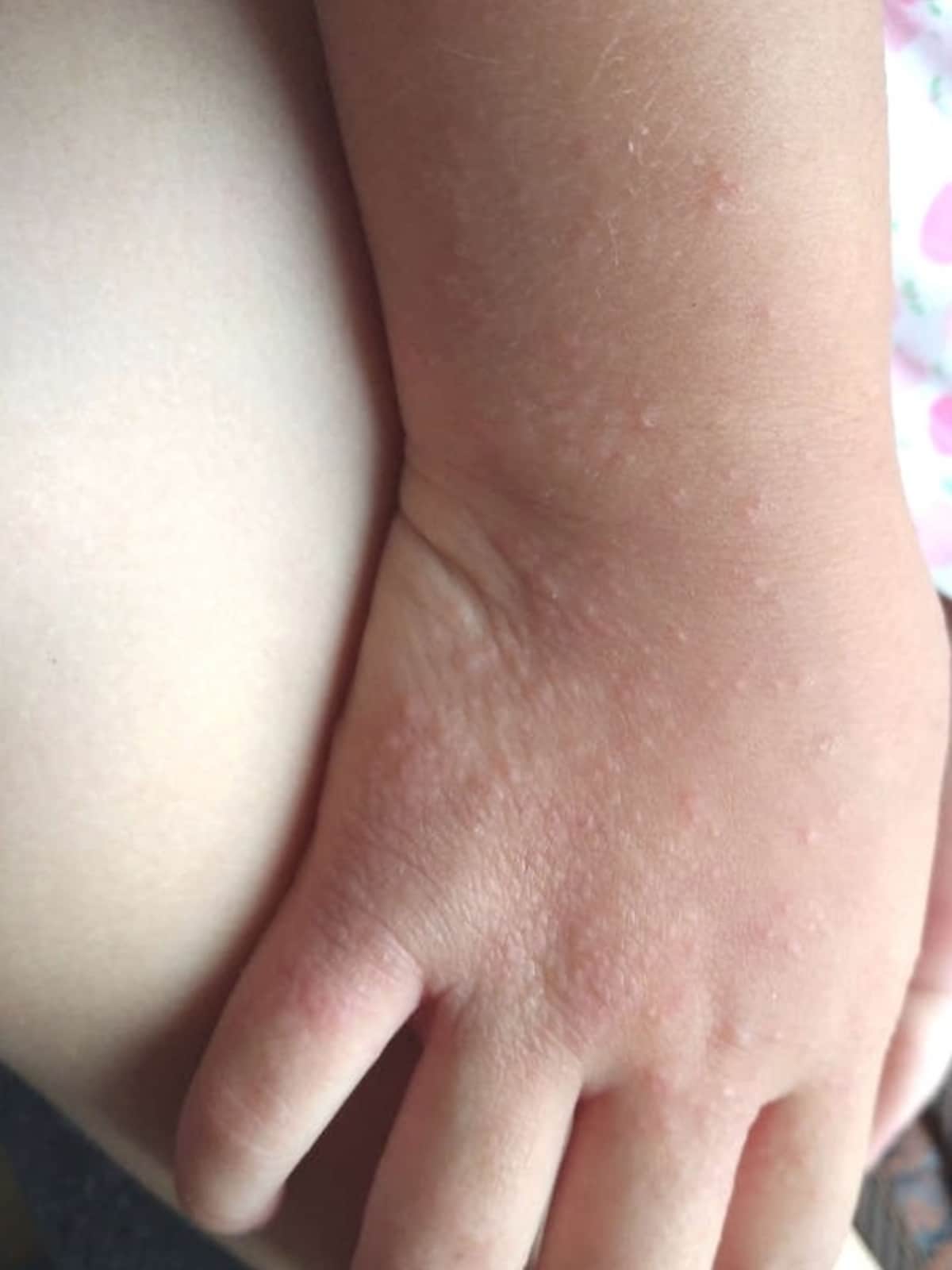 小児の手湿疹症例写真
