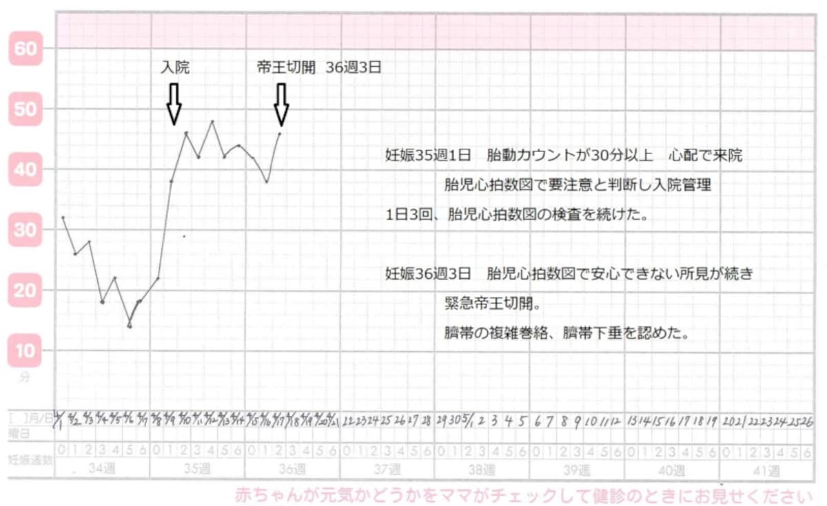 異常胎動カウントのグラフ・表（実例）