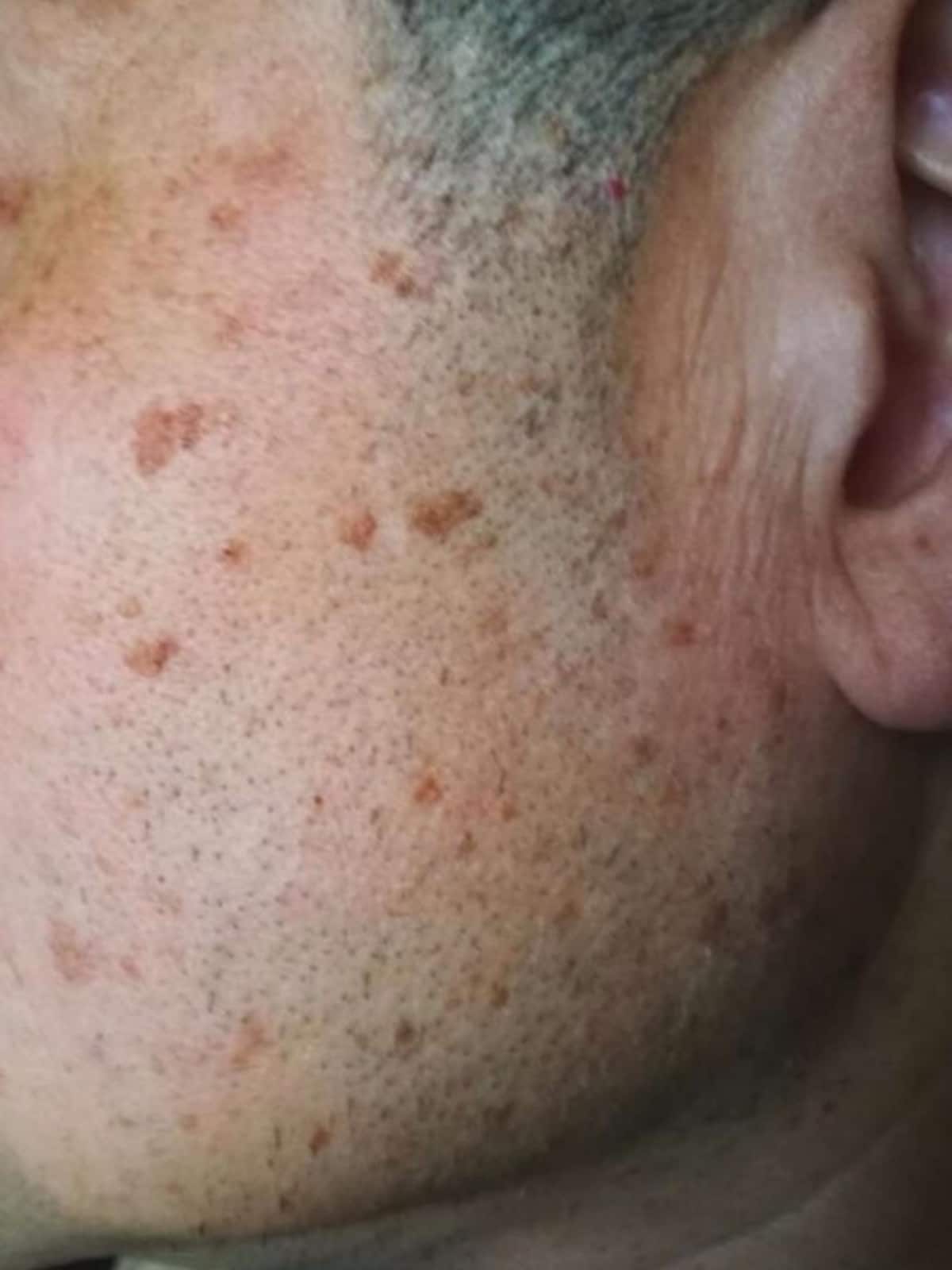 多発する比較的大型の脂漏性角化症・老人性イボ