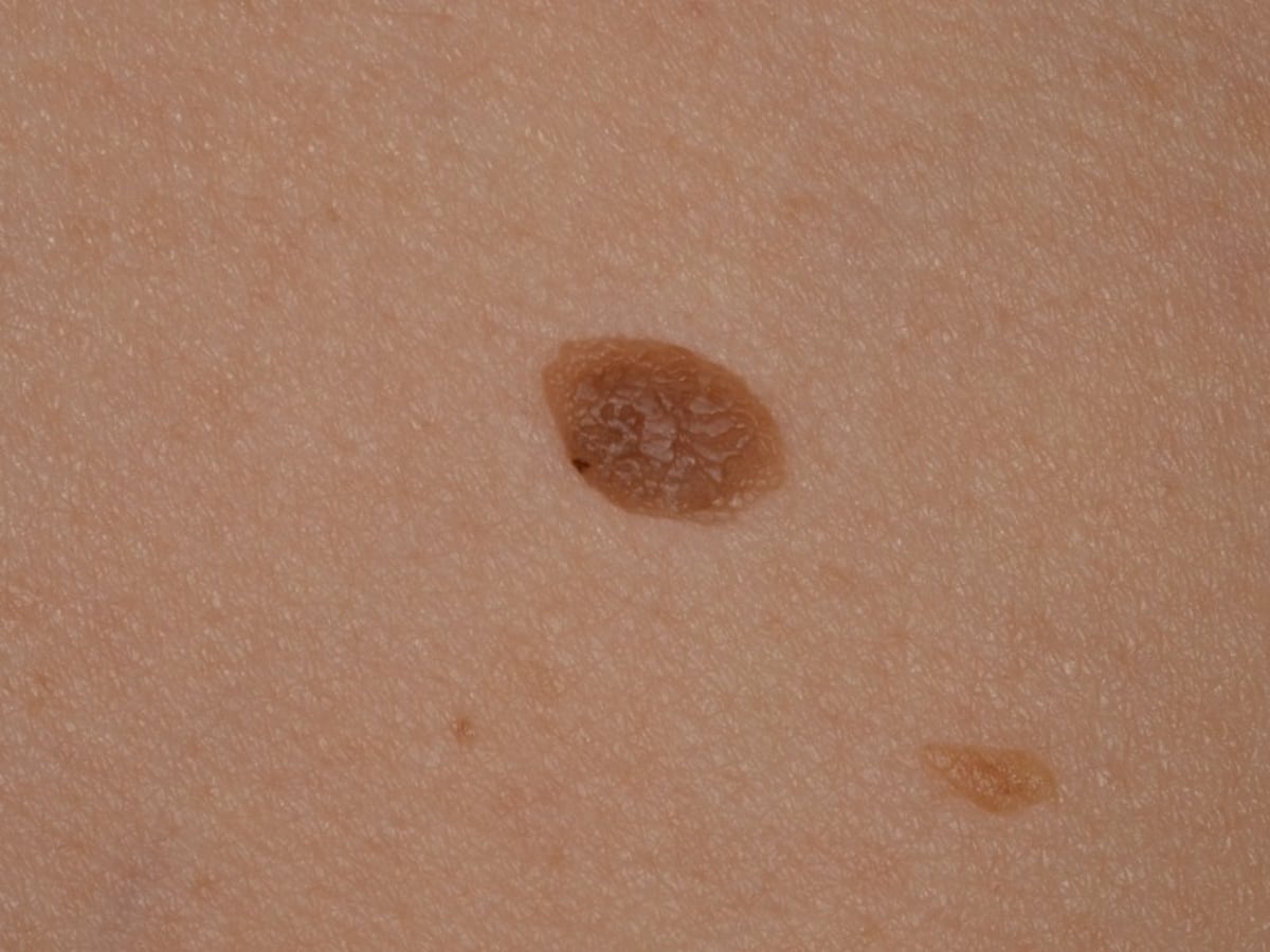 薄い茶色の脂漏性角化症・老人性イボ