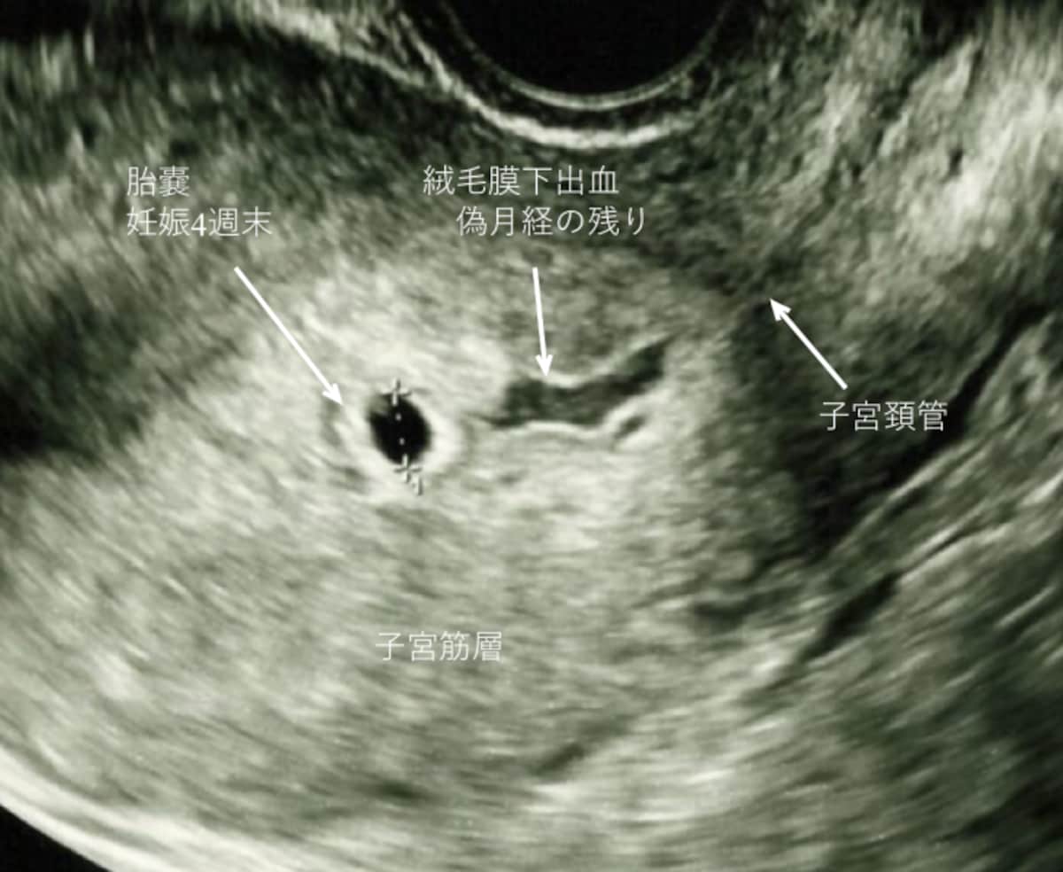 妊娠超初期の出血　予定月経期出血（偽月経）