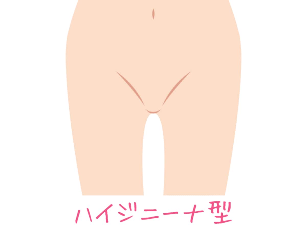VIOすべてのアンダーヘアを処理するので、衛生的ですが自己処理ではキープするのが難しいです