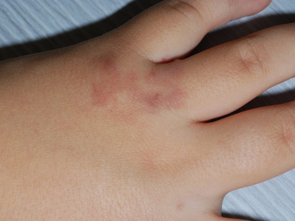 小児の手の単純血管腫