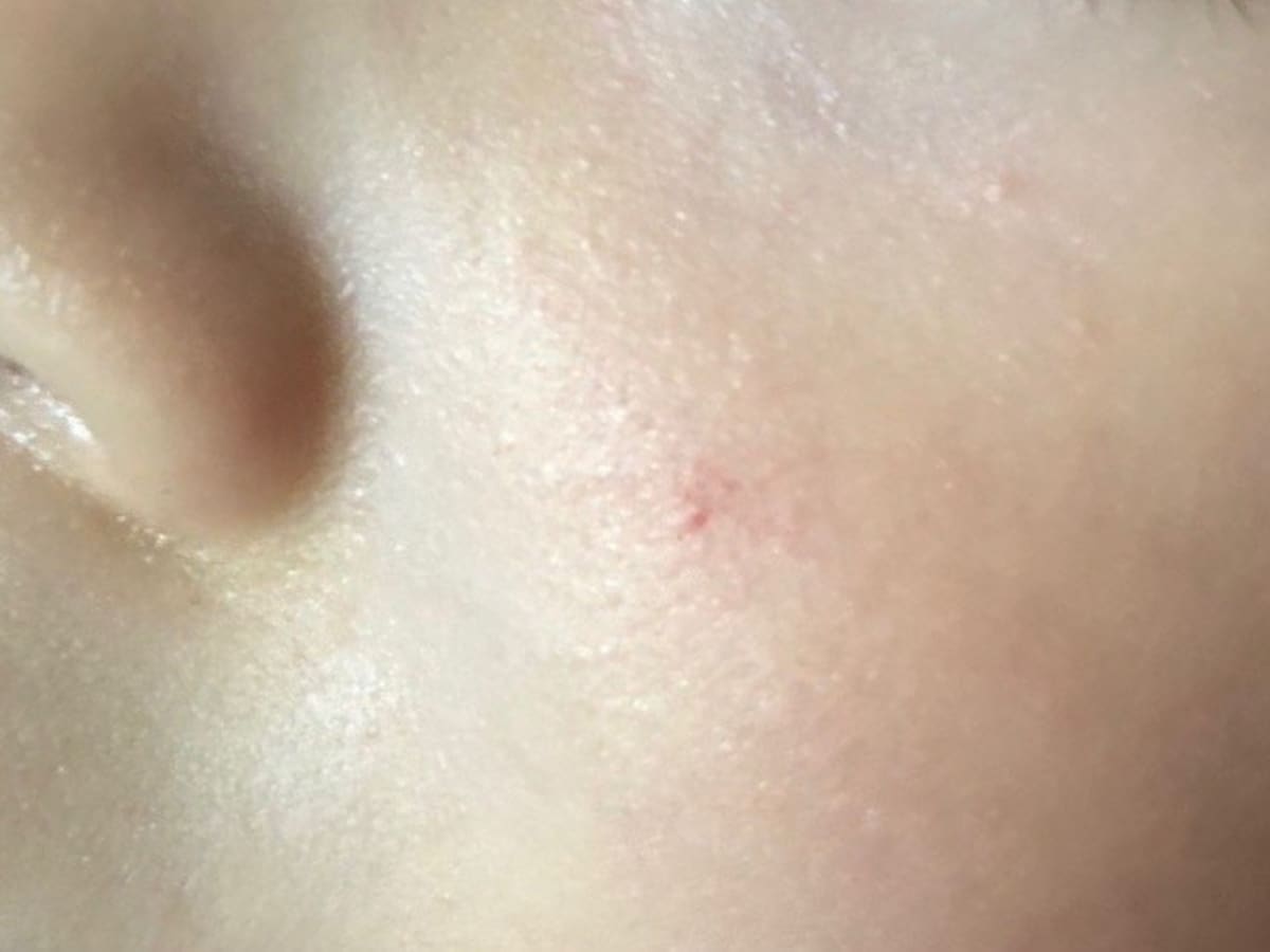 頬のくも状血管腫