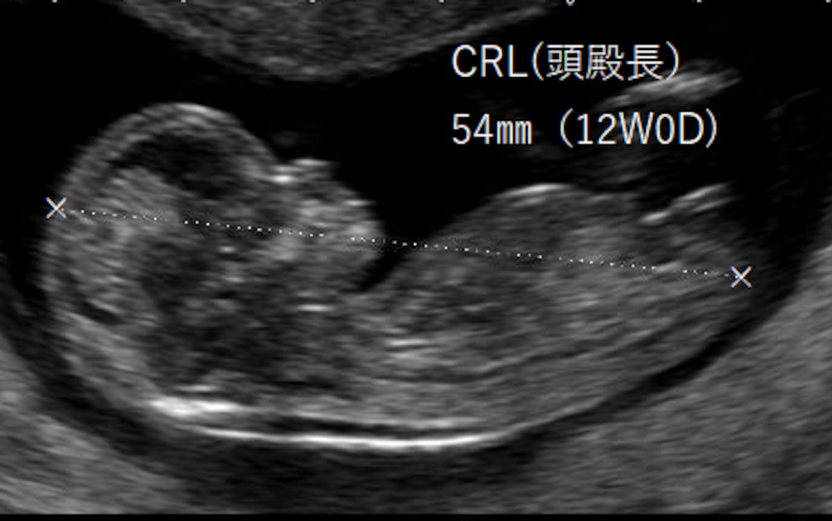 NT-CRL　　胎児の首のむくみ
