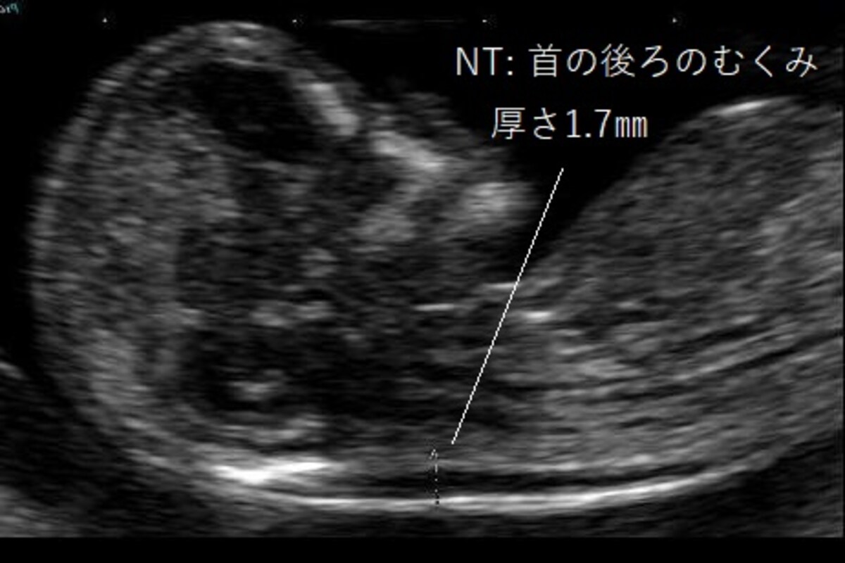 NT 胎児の首むくみ　正常