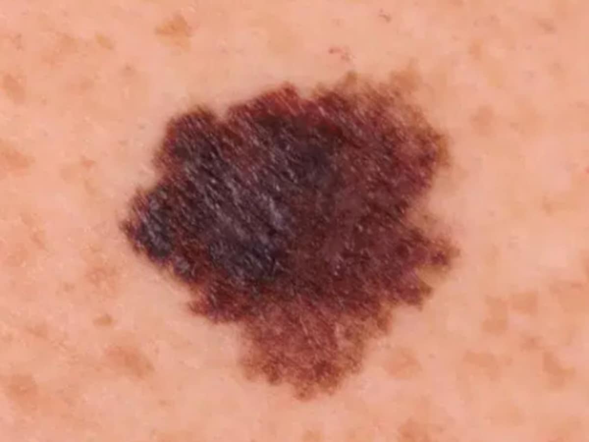 表在拡大型悪性黒色腫