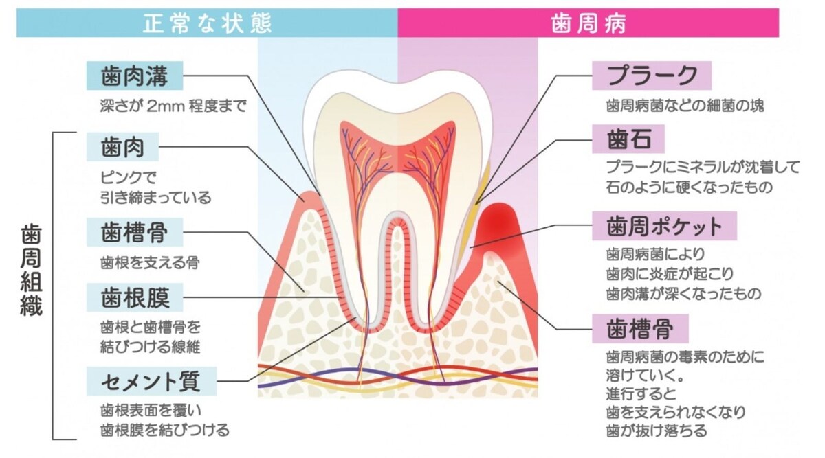 歯周病