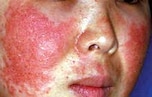 顔の湿疹は脂漏性皮膚炎 アトピー 考えられる原因と対処法 All About オールアバウト