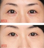なんとかしたい 年齢クマ 骨格クマ の正しい隠し方 All About オールアバウト なんとかしたい 年齢クマ 骨格クマ の正しい隠し方 All About オールアバウト