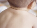 赤ちゃん・子供の「あせも（汗疹）」の原因と対処法。薬は使える？
