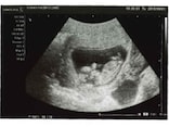 妊娠12週目エコー写真と胎児の大きさ・流産の壁の実際