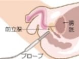 前立腺がんの症状・診断