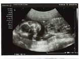妊娠20週目エコー写真・胎児の大きさや胎動の様子・性別