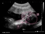 妊娠24週目 エコー写真で見る胎児大きさと体重・早産になったら