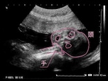 妊娠24週目 エコー写真で見る胎児大きさと体重・早産になったら