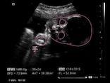 妊娠30週 胎児の体重や大きさをエコー写真で確認・逆子や早産の心配