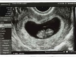 妊娠8週目 エコー写真や胎児の大きさ平均・つわりや流産症状