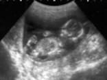 妊娠13週目エコー写真と胎児の大きさ・性別や胎動はいつわかる？