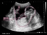 妊娠14週目エコー写真・胎児の大きさ・お腹の張りは大丈夫？