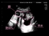 妊娠15週目エコー写真や胎児の大きさ・胎動・お腹の張りは？