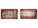 装置を着けない歯並び治療の具体的なポイント